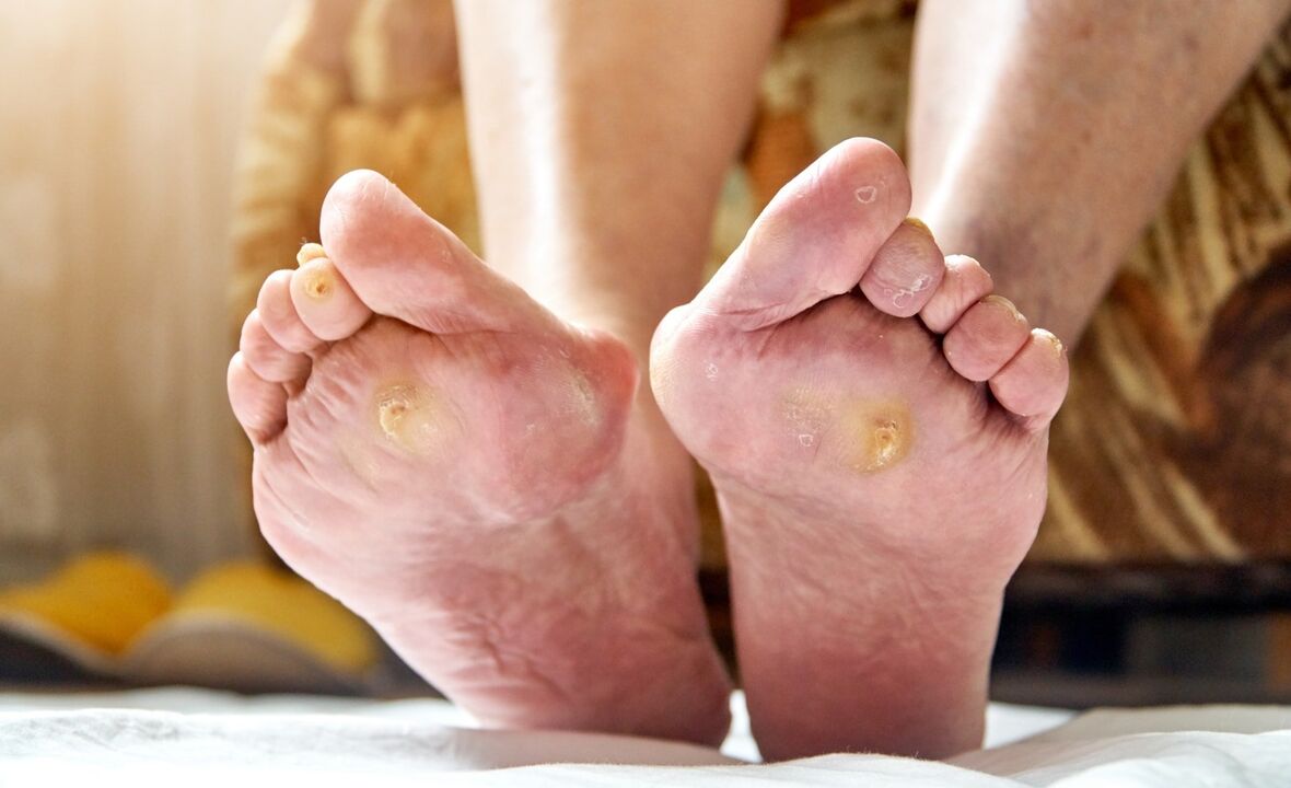 diabetes voet