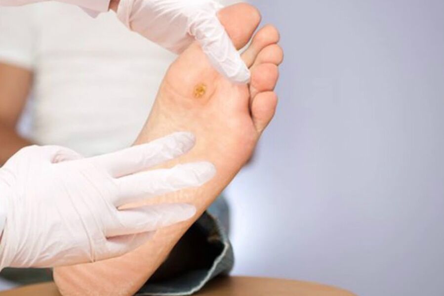 Diabetische voet - Ernstige complicatie van diabetes
